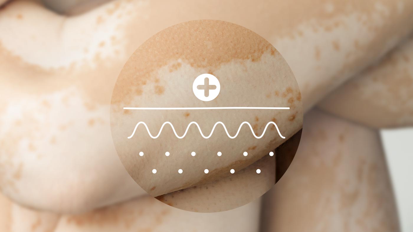 Haut mit Pigmentstörung