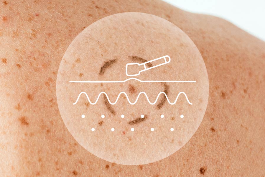 Vorsorgeuntersuchung für Hautkrebsvorsorge und -therapie